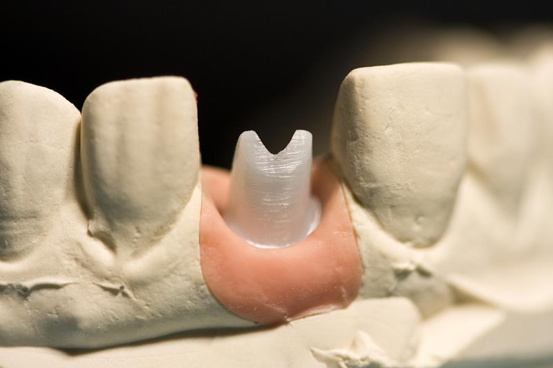 Implant Restoration Kingsford, MI